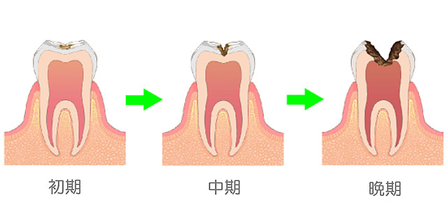 むし歯の進行